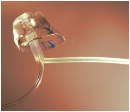 click earmould for open fitting hearing aids